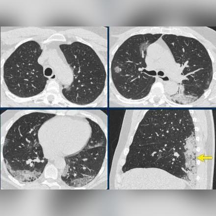 “新型冠状肺炎病毒最新消息” 新型冠状肺炎病毒肺炎最新情况？