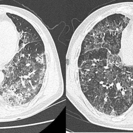 【新冠肺炎官方最新数据/新冠肺炎官方最新数据表】